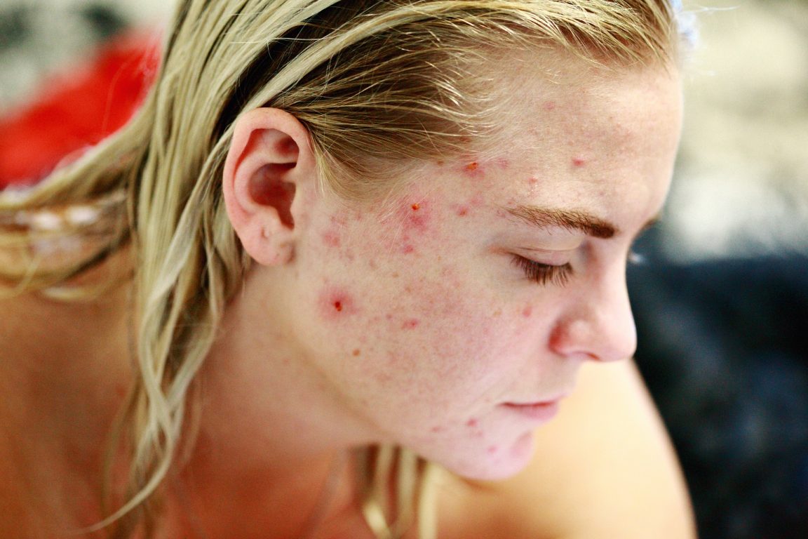 MUST READ: Top 10 Foods That Cause Acne