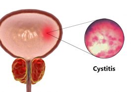 Do Women Have Cystitis More Than Men?