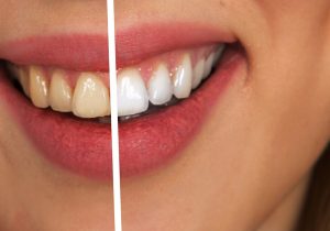 Best and Simpler Way to Whiten Your Teeth